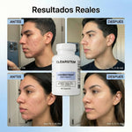 MINDBODYSKIN® - Acaba con el Acné Hormonal en 7 Días.